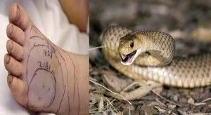 snake-bite