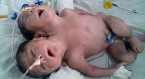 two-headed-baby-boy1