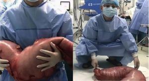 Something weighs 13 kg and 13 inches in length found during surgery of stomach