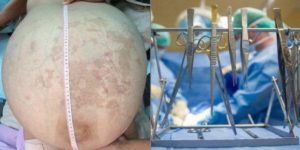 Woman-got-a-tumor-in-her-stomach-developed-7-years-ago