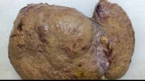 liver cirrhosis 02 09 2024 17252630604939782531262705874